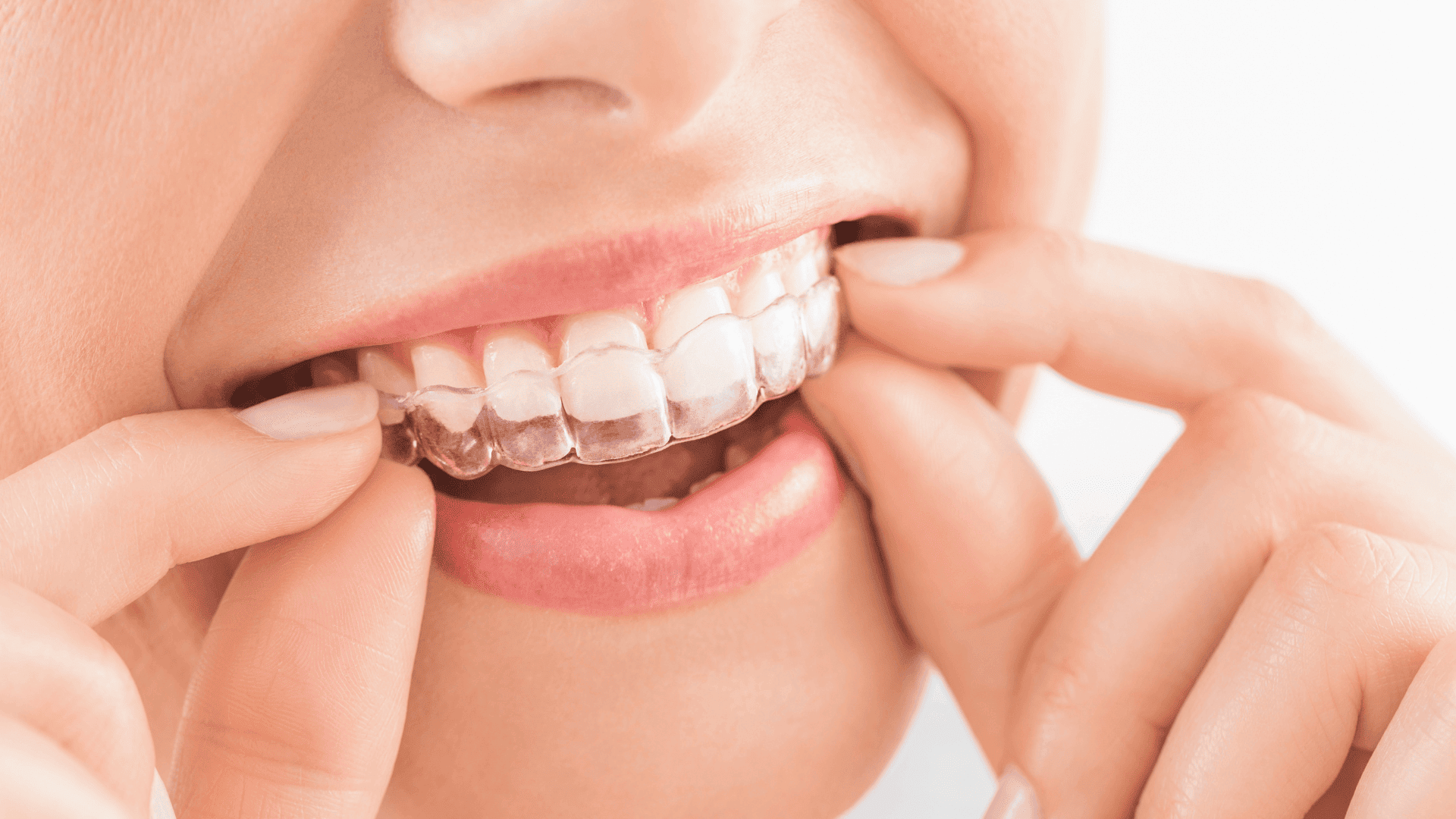 Cosmetic Dentistry: Invisalign